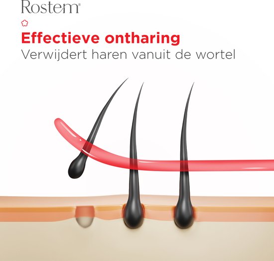 Illustratie van haren die vanuit de huid worden verwijderd met Rostem ontharingswax.