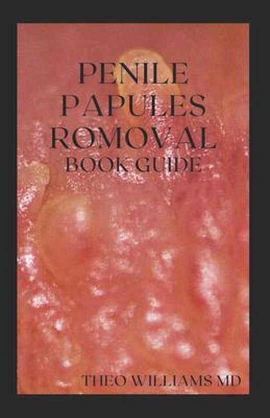 Papules home penile remedies removal Pearly Penile
