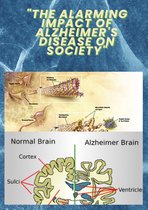 "The Alarming Impact of Alzheimer's Disease on Society"