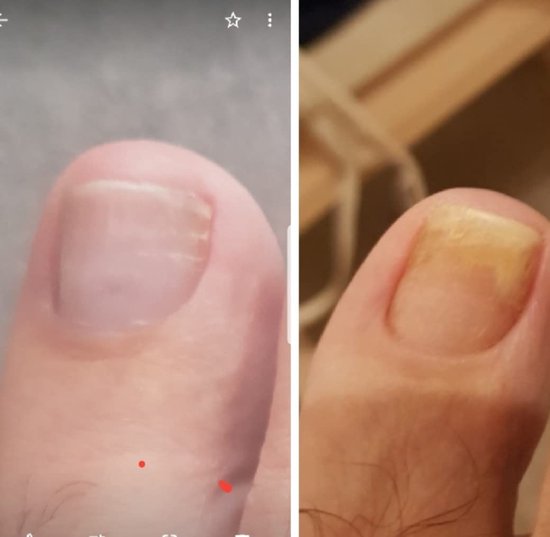 Effectieve Teennagelverzorging – Kalknagelbehandeling - Voor Verkleuring, Verdikking en Broze Nagels – Intensieve Kalknagel Verzorging voor Schimmelnagel en Nagelschimmel – Zonder Water – XL 75ML - Anti Kalknagel Behandeling