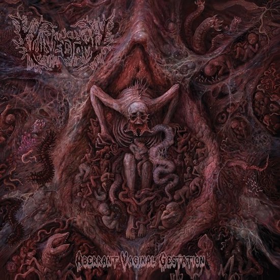 Vulvectomy - Aberant Vaginal Gestation (CD)