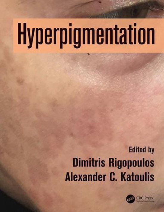 Hyperpigmentation - cover
