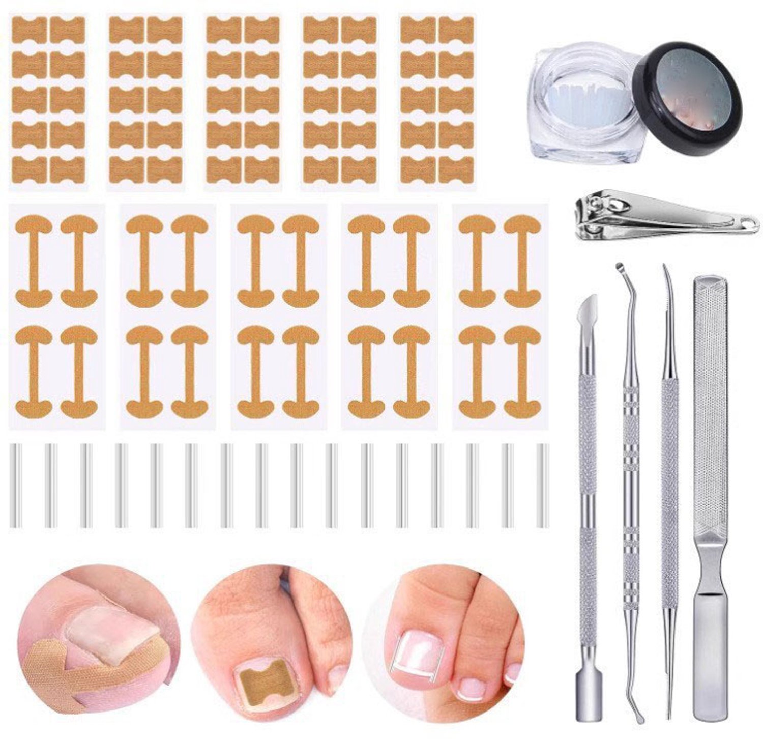 16 stuks - nagelbeugel - ingegroeide teennagel - ingegroeide teennagel - ingegroeide teennagel tool -ingegroeide teennagel pleister -ingegroeide teennagel gaas - nagelbeugeltjes ingegroeide nagel