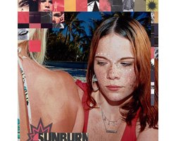 Sunburn