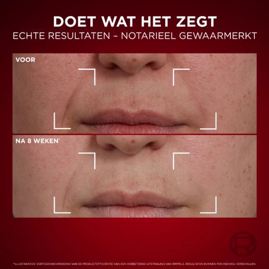 Voor en na 8 weken behandeling: de huid rond de mond toont minder rimpels.