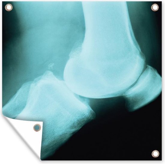 Tuin decoratie Een röntgenfoto van een Artritis knie - 30x40 cm - Tuindoek - Buitenposter