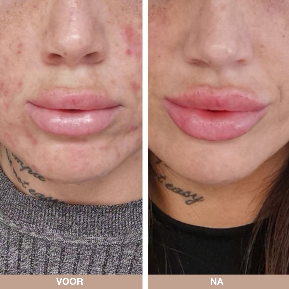 Australian Bodycare Anti - Puistjes pakket met Tea Tree Olie thumbnail 3