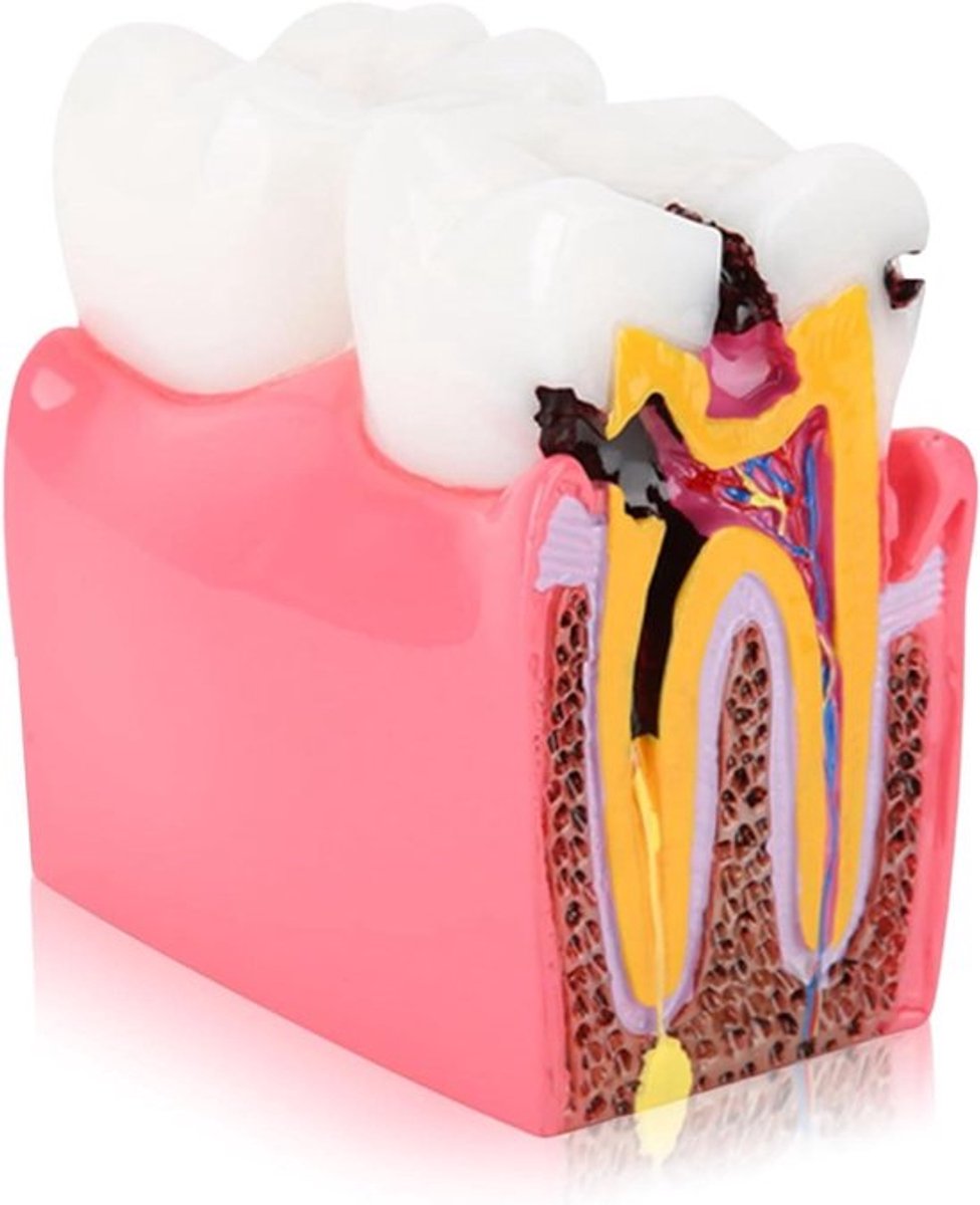 Dentale Anatomie-model voor tandarts-onderwijs en cariësstudie. Anatomische tandenmodel voor cariësvergelijking.