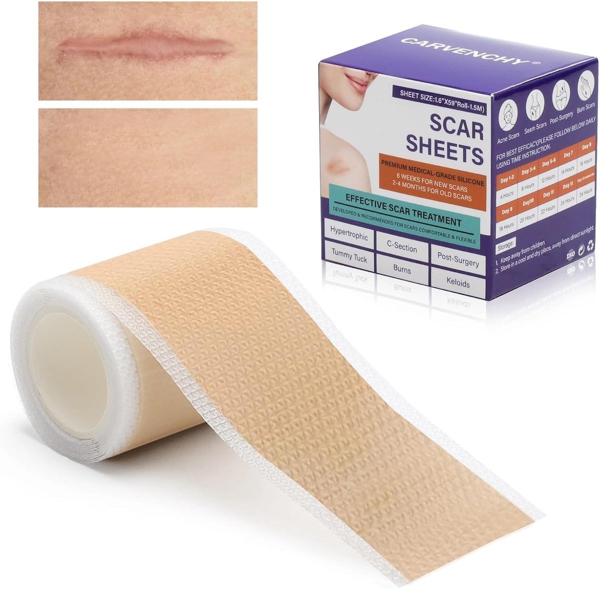 Herbruikbare Silikon Littekentape 1.5M voor Caesarean Sectie, Acne en Chirurgische Littekens - Effectieve Littekens Verwijderen en Huidherstel