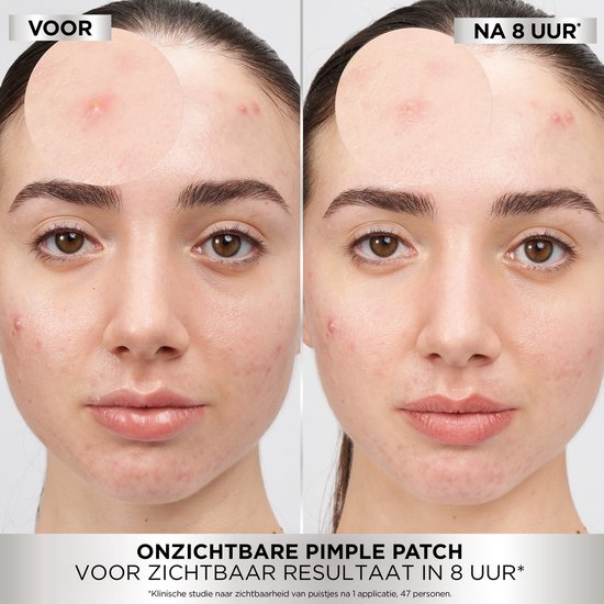 Voor en na foto's van een vrouw met puistjes, behandeld met Garnier PureActive Invisible Pimple Patch. Links vóór, rechts na 8 uur.