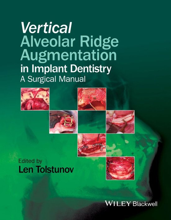 Vertical Alveolar Ridge Augmentation in Implant Dentistry (ebook), Len ...