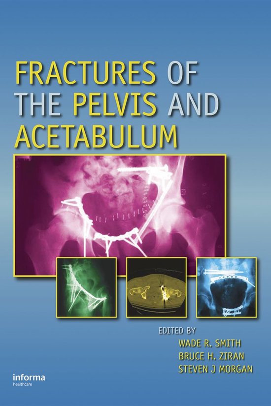Fractures of the Pelvis and Acetabulum - cover