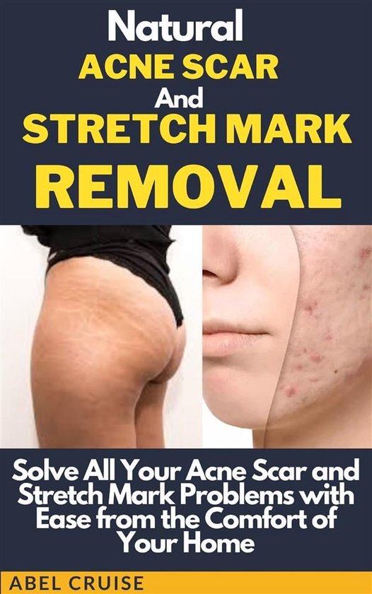 Natural Acne Scar and Stretch Mark Removal - cover