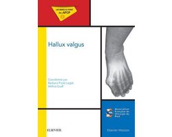 Hallux valgus