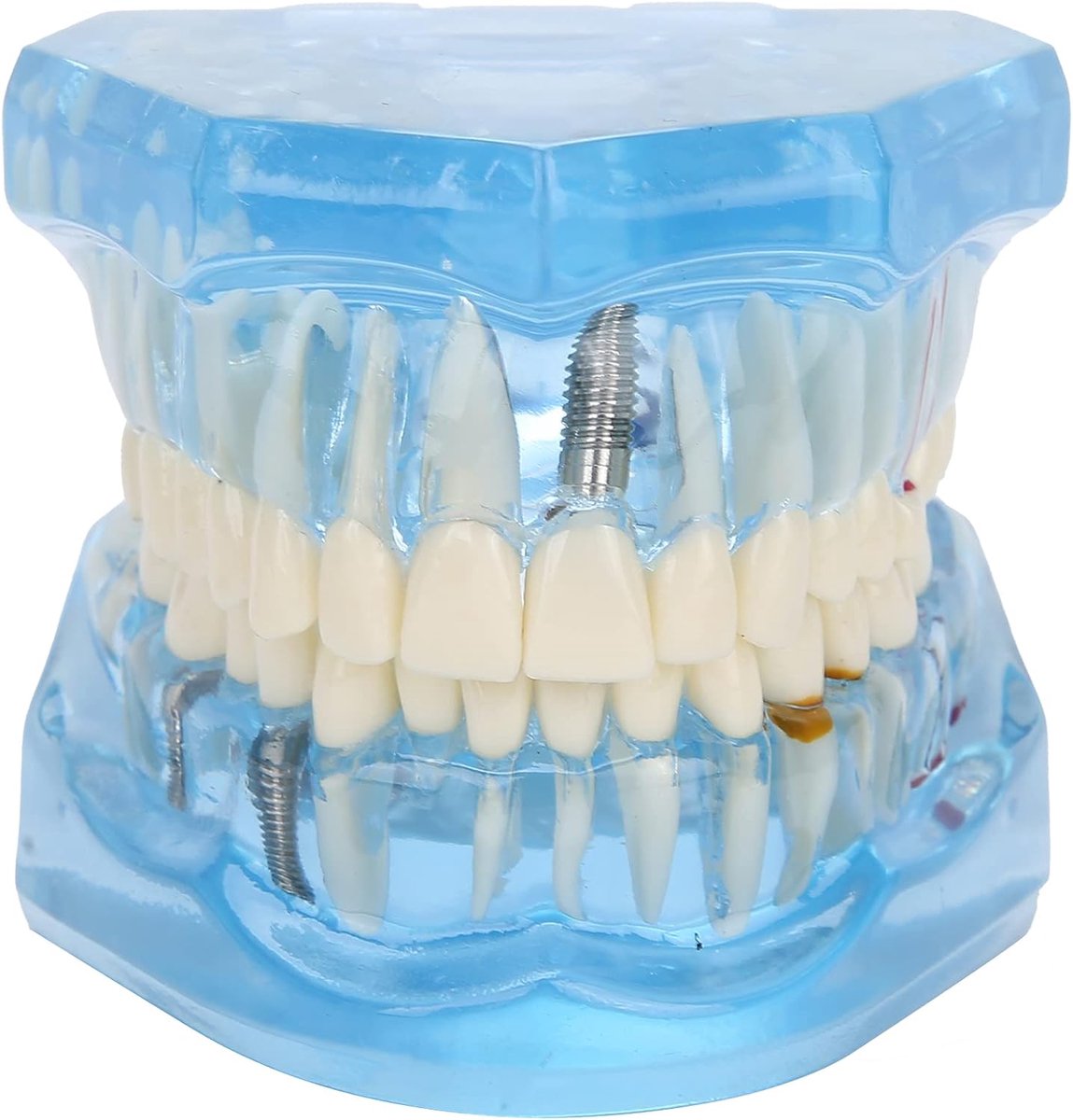 Dental Oral Typodont Model, Acrylic Blue Dental Models, Transparent Mouth Model, Teeth Model Compatible For Dental - ShopVlot