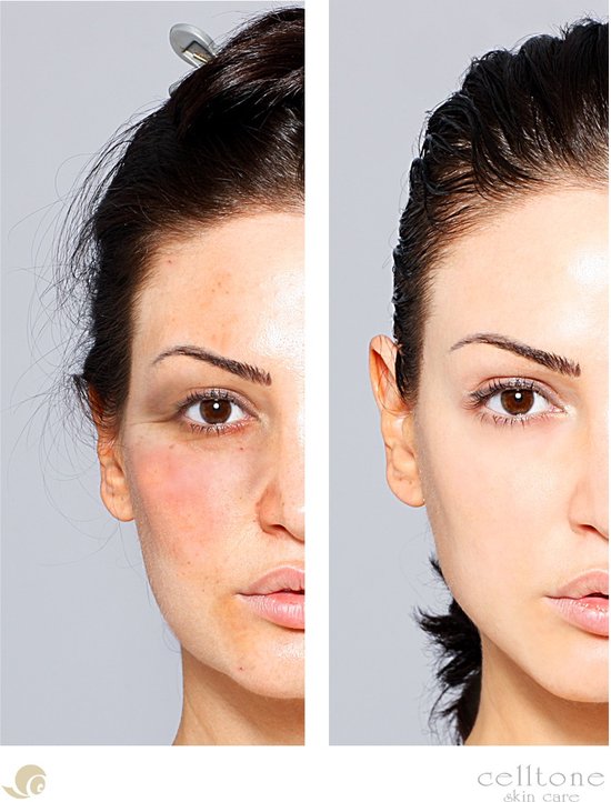 Celltone Dagcrème Slakkenslijmcrème - 50 ML - Anti rimpel - Littekencrème - Slakkencrème voor acne puistjes rimpels - Acneverzorging - Slakken Extract serum gel voor vrouwen mannen tieners - escargot cream voor gezicht en onder de ogen - Snailcare