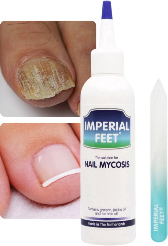 Effectieve Teennagelverzorging – Kalknagelbehandeling - Voor Verkleuring, Verdikking en Broze Nagels – Intensieve Kalknagel Verzorging voor Schimmelnagel en Nagelschimmel – Zonder Water – XL 75ML - Anti Kalknagel Behandeling