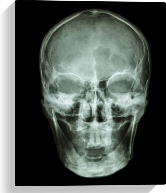 Canvas - Röntgenfoto van Mensenschedel - 30x40 cm Foto op Canvas Schilderij (Wanddecoratie op Canvas)