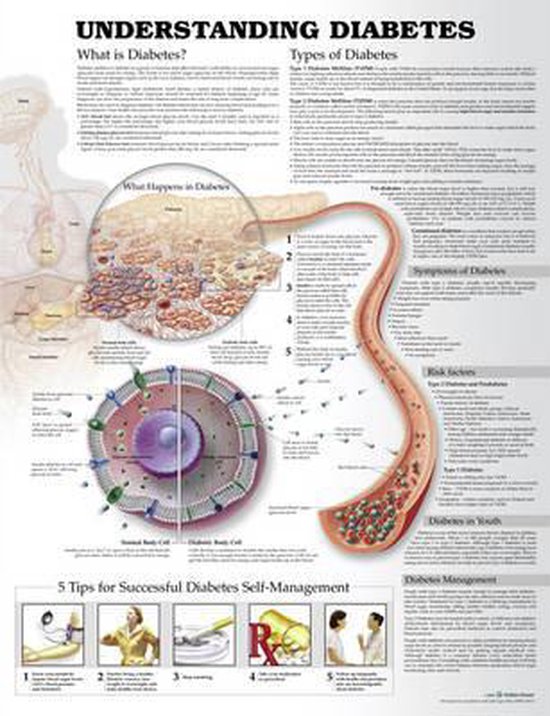 Anatomical Chart Understanding Type 2 Diabetes – Poster 50,8 X 66 Cm, Laminiert