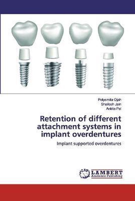 Retention of different attachment systems in implant overdentures