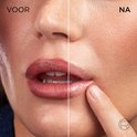 Voor en na foto van een mond, lippen en kin. De huid ziet er voller en gladder uit na gebruik.