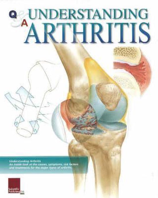 Understanding Arthritis Flip Chart