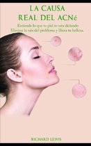 La Causa Real Del Acne
