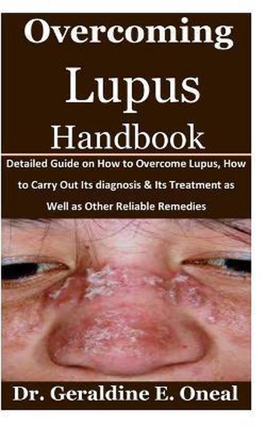 Overcoming Lupus Handbook - cover