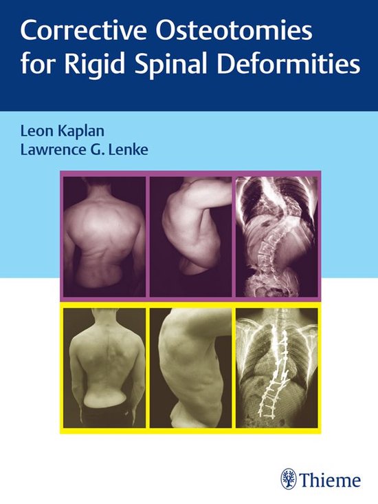 Corrective Osteotomies for Rigid Spinal Deformities - cover