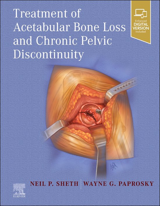 Treatment of Acetabular Bone Loss and Chronic Pelvic Discontinuity