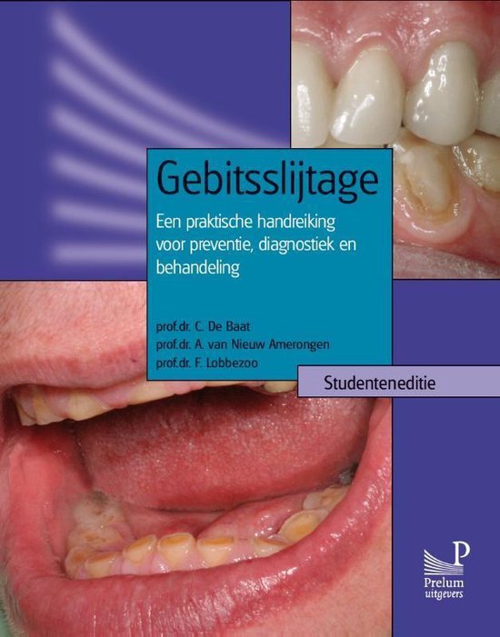 Cover van het boek 'Gebitsslijtage / Studenteneditie / druk 1'