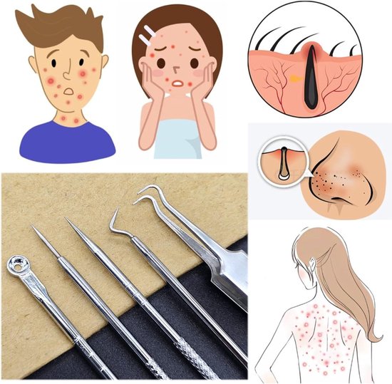 SnelShoppen - 5x Blackhead Remover Tool Set, Comedone Extractor, Milia ...