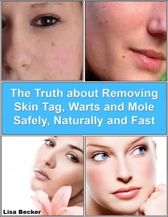 The Truth About Removing Skin Tag, Warts and Mole Safely, Na ... - cover