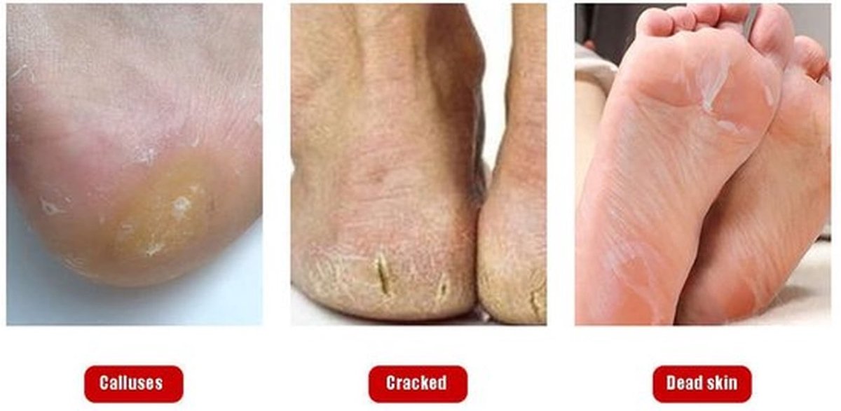 Eelt Scheerapparaat van Roestvrij Staal voor Pedicure