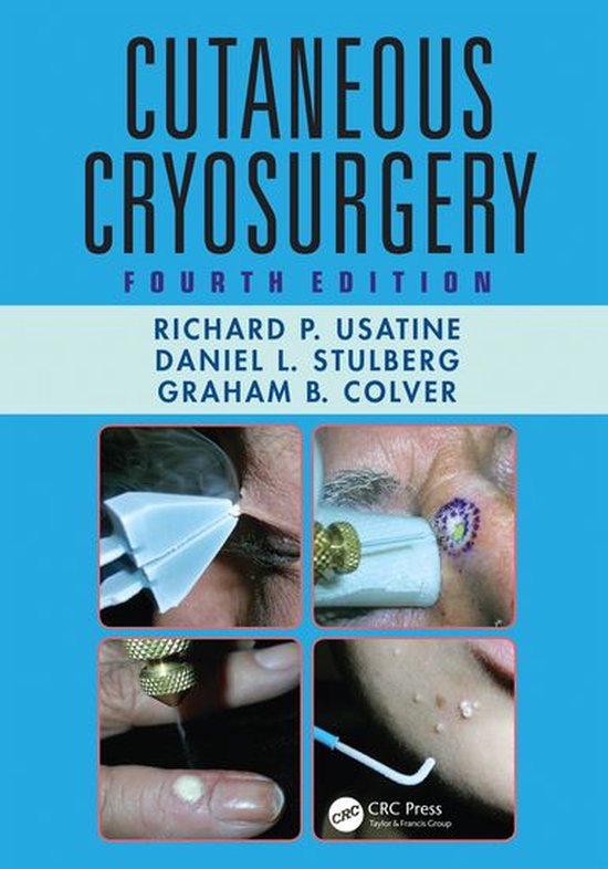 Cutaneous Cryosurgery - cover